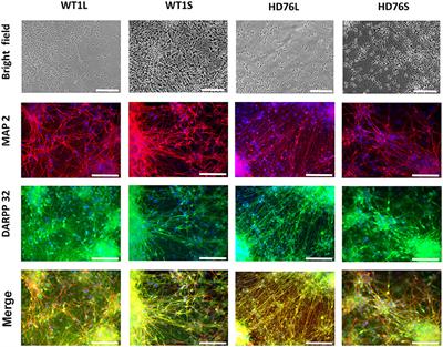 STIM2 Mediates Excessive Store-Operated Calcium Entry in Patient-Specific iPSC-Derived Neurons Modeling a Juvenile Form of Huntington's Disease